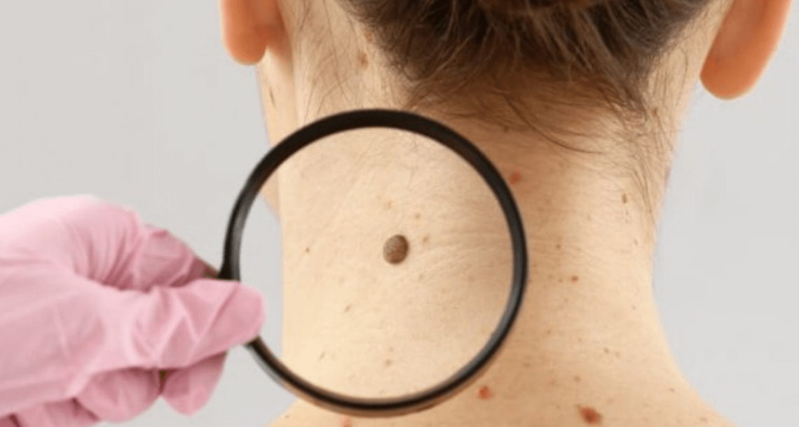 מהפכה בהסרת שומות וסרחי עור: טיפול אחד בלבד, בלי כאב, בלי צלקות