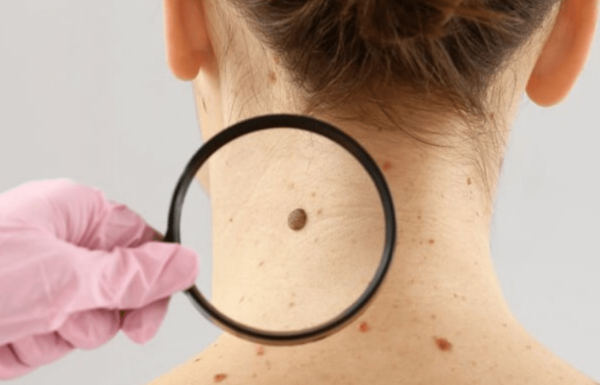 מהפכה בהסרת שומות וסרחי עור: טיפול אחד בלבד, בלי כאב, בלי צלקות